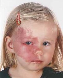 Zdjęcie przedstawia dziewczynkę z znamieniem na twarzy