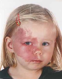 Zdjęcie przedstawia dziewczynkę z znamieniem na twarzy